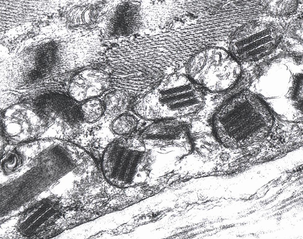 Kearns-Shy syndrome - abnormal mitochondria with paracrystalline inclusions